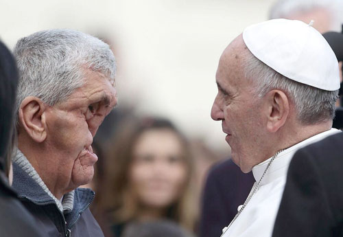 بابا الفاتيكان يلتقي رجل مشوه بدون وجه