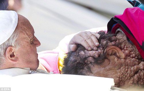 بابا الفاتيكان يقبل رأس رجل مريض بمرض جلدي خطير